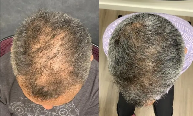 PEPFACTOR BEFORE AND AFTER