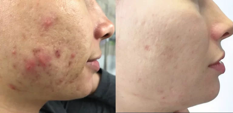 PepFactor Skin Before and After